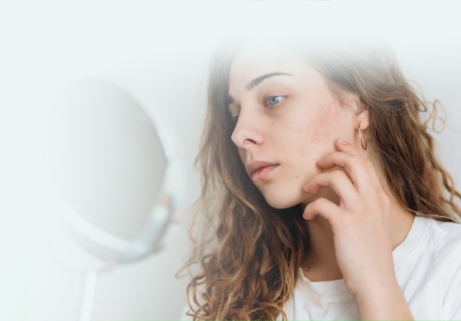 Acne Treatment