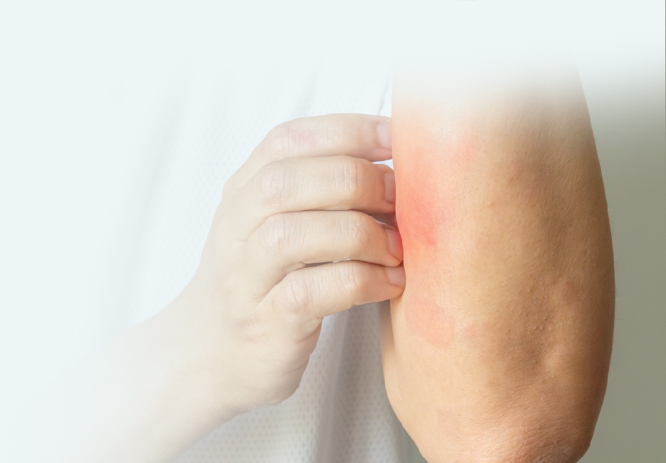 Eczema & Psoriasis
